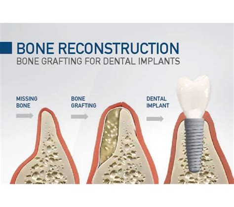 guided bone regeneration dental.